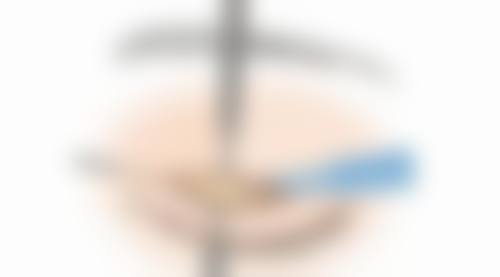 富贵包螺旋刀微创技术：价格与适用人群分析