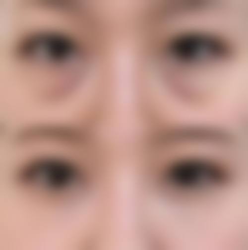 三、眼袋形成的原因