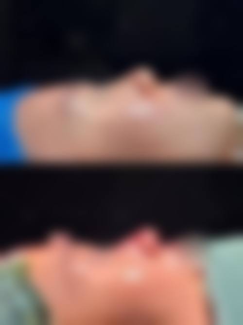 个人体质与隆鼻假体终身留存