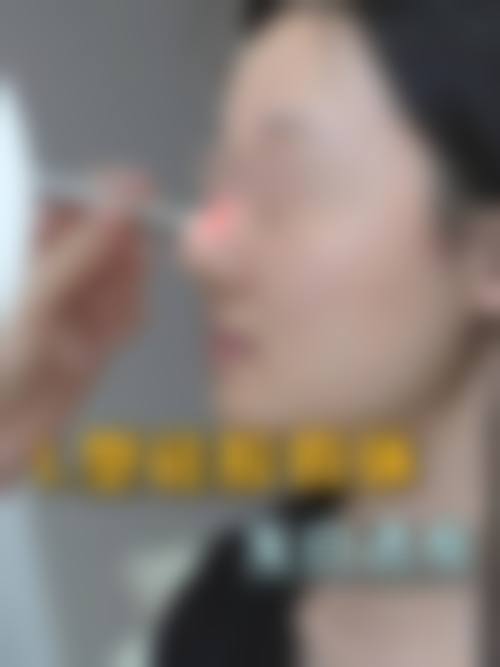 隆鼻假体终身留存的注意事项