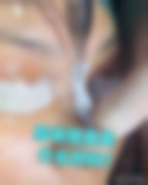 术后护理与隆鼻假体终身留存