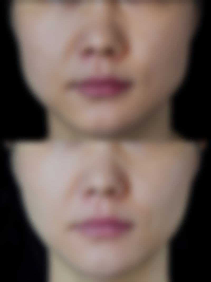 富贵包螺旋刀微创技术：创伤小修复快的秘密武器
