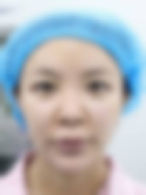 宽改窄修复：重塑自然双眼皮形态