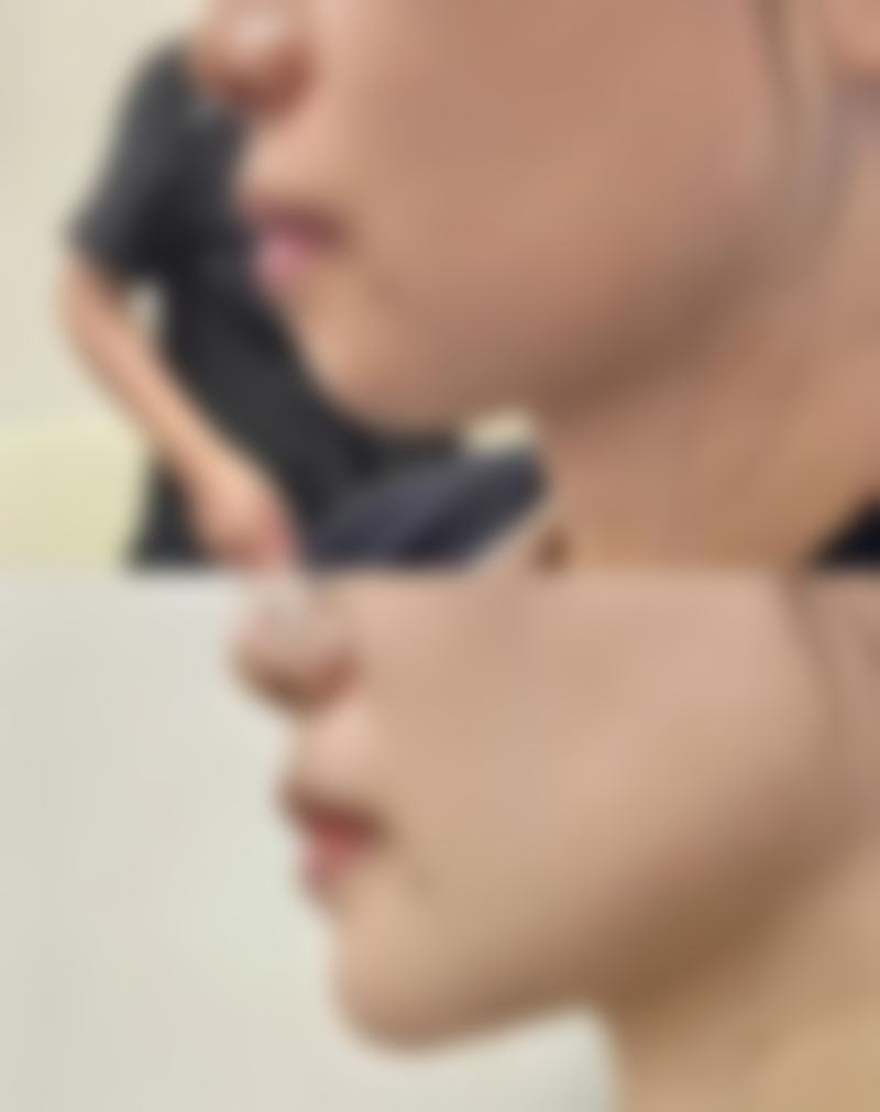 骨骼宽大宽脸打瘦脸针有效吗