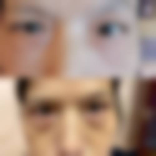 六、手术治疗眼袋有哪些风险和注意事项？