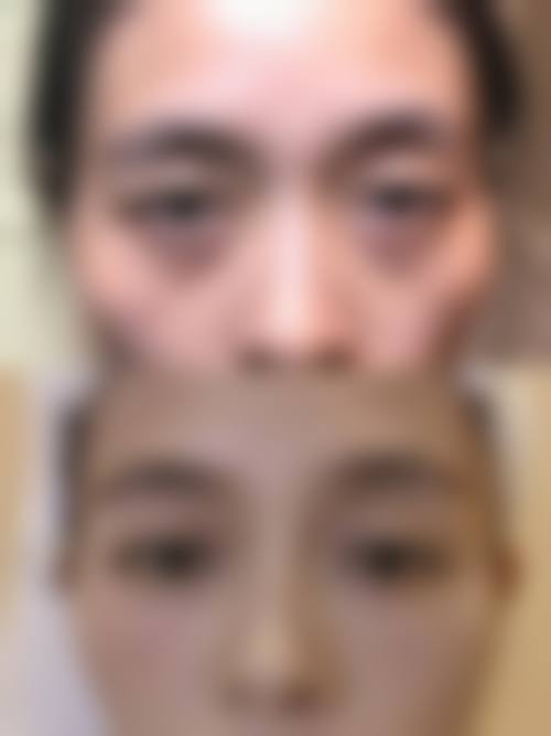 三、眼袋形成的原因及解决办法有哪些？
