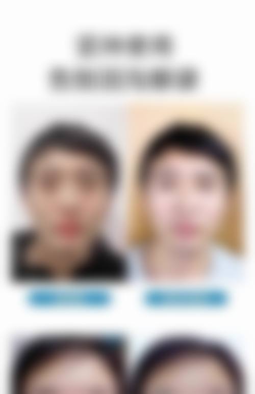 如何有效去除眼袋和黑眼圈,有哪些方法？不同成因对应方案解析
