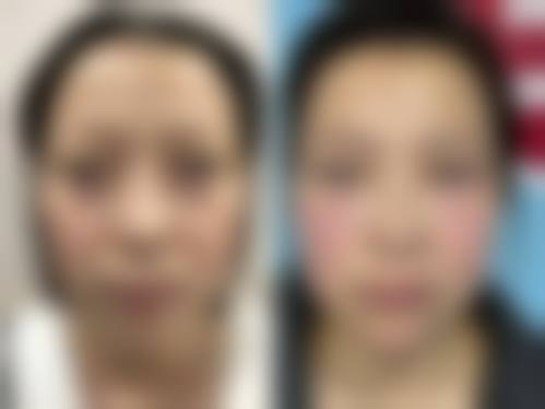 激光治疗：高新科技助力告别眼袋
