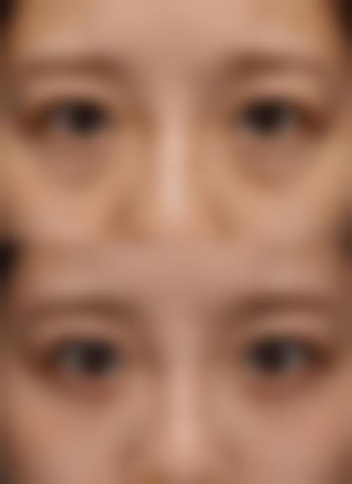 如何去除脸上的眼袋？可通过调整作息、冷敷消肿、激光治疗改善，严重者还能手术切除！ 