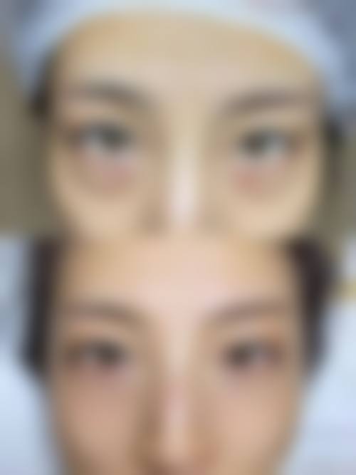 四、去眼袋眼霜对遗传性眼袋有效吗？