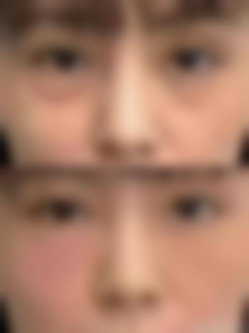 七、去眼袋眼霜与医美手段相比，哪个更有效？