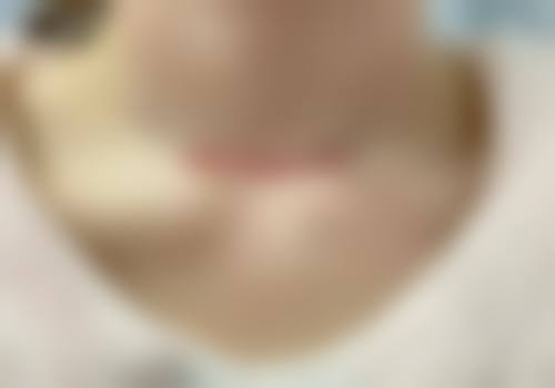 增生性疤痕压力治疗方案