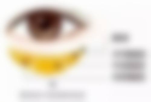 黑眼圈与眼袋的治疗方法不同