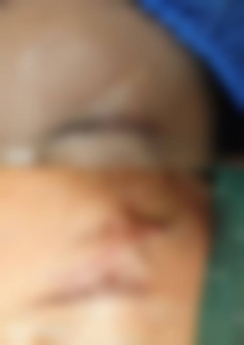 中医内服药物治疗疤痕疙瘩