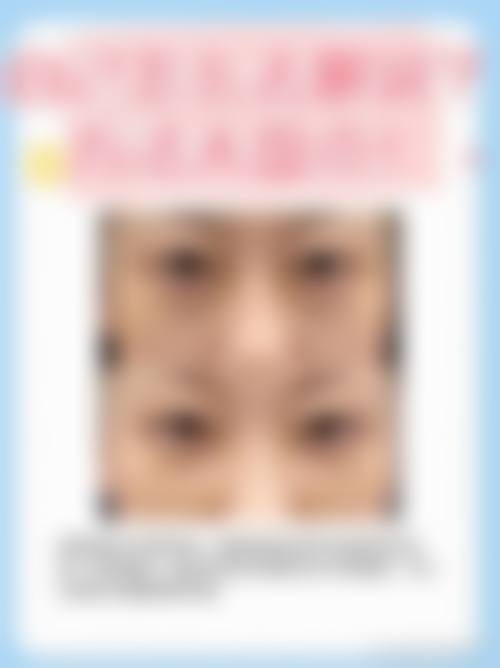 多年的眼袋怎么消除之物理治疗