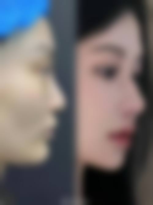 耳软骨隆鼻要住院吗？别慌！多数情况观察1 - 2小时，不用住院哒 