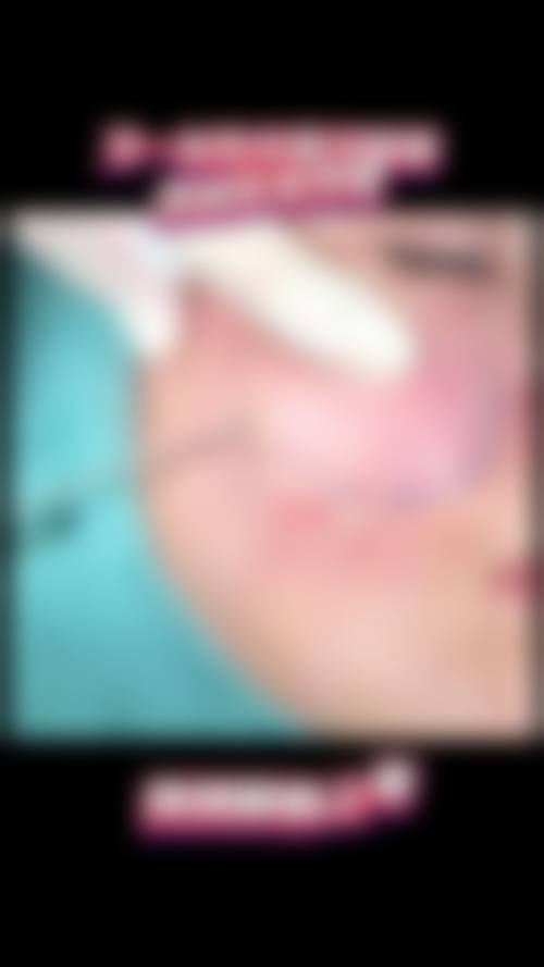 北京艺美巩敏院长做取面部异物怎么样？三维减容修复术+高性价比，闭眼冲！ 