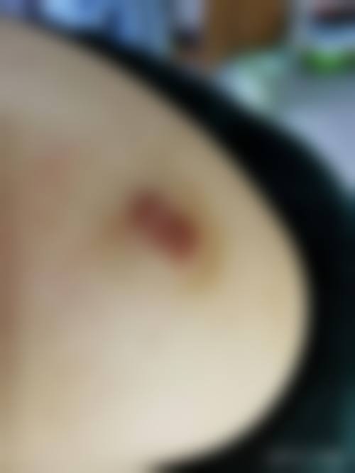 五、优福通激光治疗