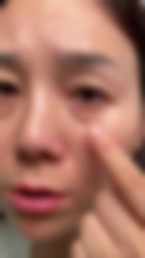 低价去眼袋背后的骗局