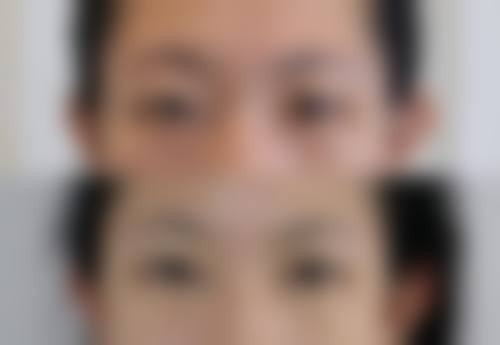 上海市东方医院整形美容中心价格表及案例：隆鼻4000-30000元，双眼皮3000-6500元！ 