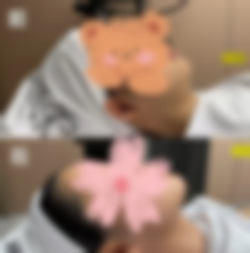 脸上去痣留下的疤痕怎么去？激光、药物、微针治疗等多管齐下，有效去除不是梦！ 