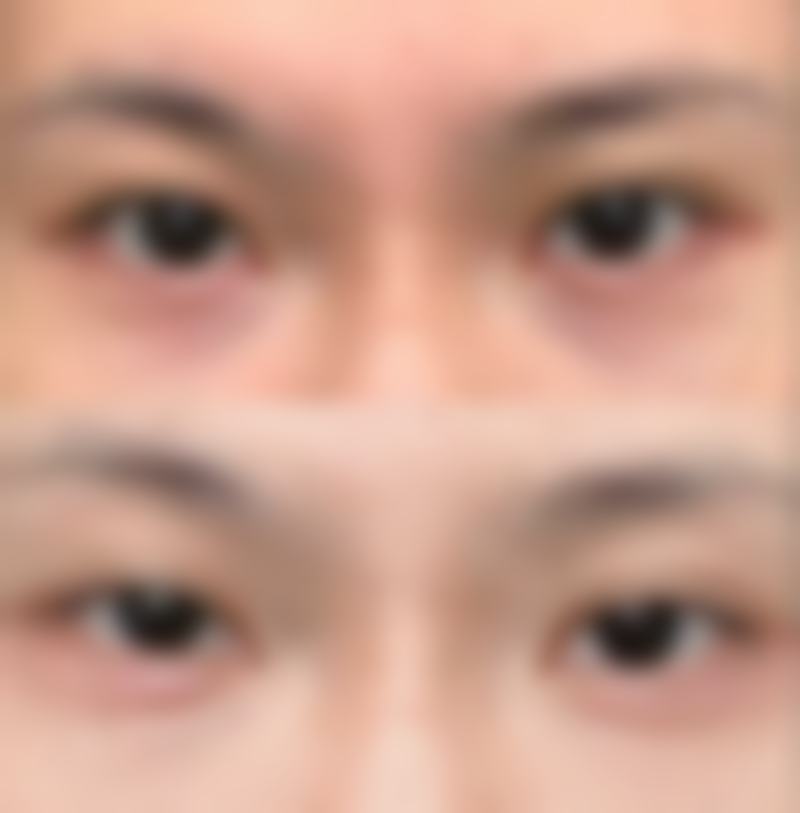 药物涂抹：软化增生、淡化色素，多种药物各显神通