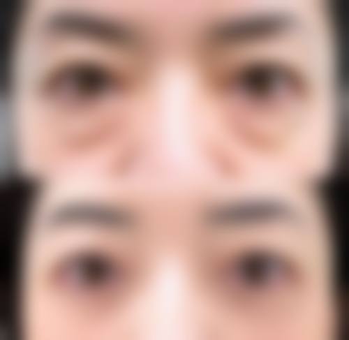 什么去除眼袋效果好,手术、激光、眼霜等方法怎么选？适用情况大揭秘