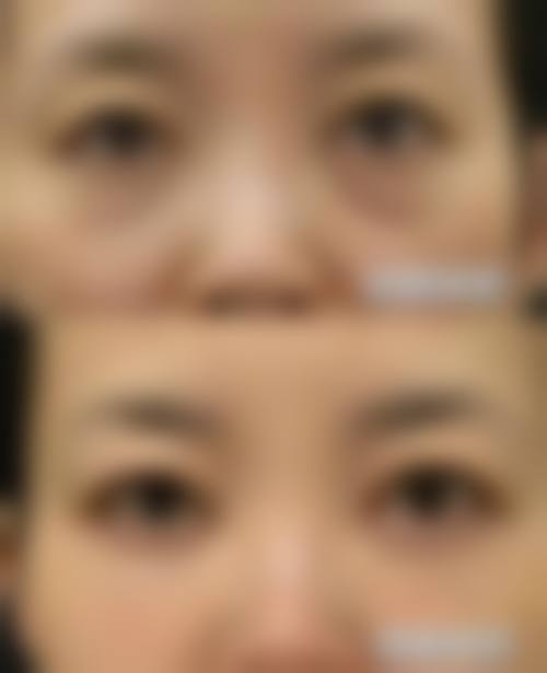 二、手术去眼袋成效如何？
