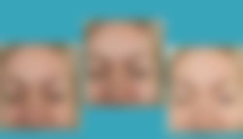 除皱针打了要注意遵医嘱复查