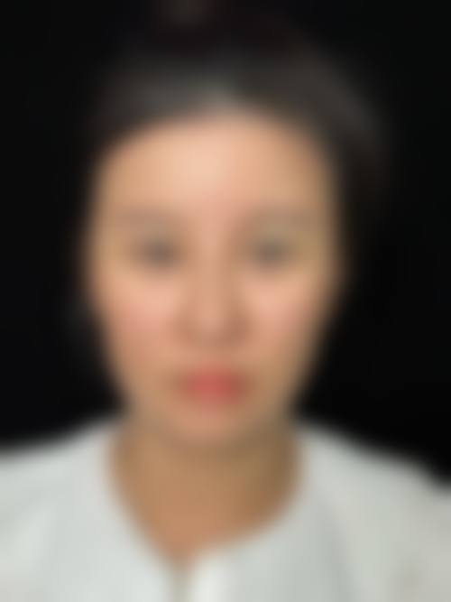 为什么选择南京华美眼部整形