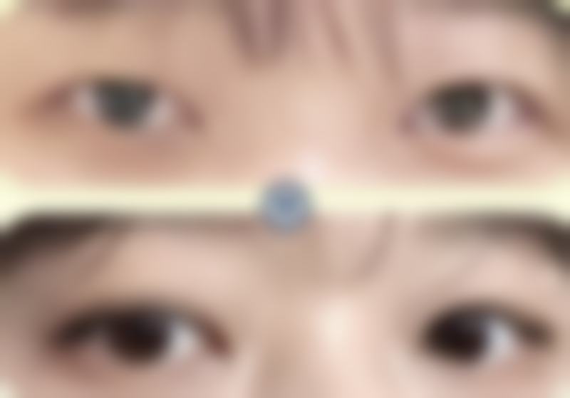 切开双眼皮维持时间与医院的关系