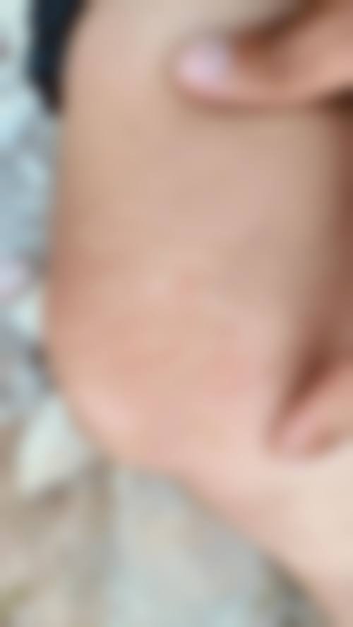三、沈阳辽沈华美医院(疤痕科)的新型技术