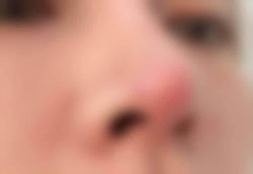 八、如何确保半肋骨隆鼻成效的长久维持