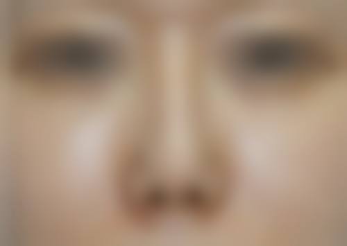 四、个体差异如何影响半肋骨隆鼻的长久成效