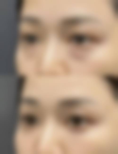 四、男士去眼袋的有效方法