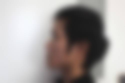 二、手术材料对半肋骨隆鼻恒久性的影响
