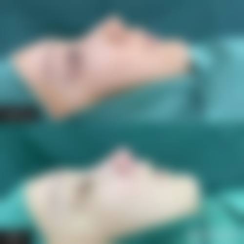 三、术后护理对半肋骨隆鼻恒久性的作用