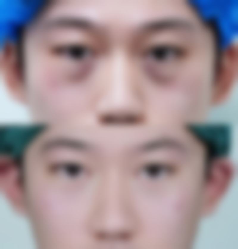 五、如何选择适合自己的去眼袋方法?