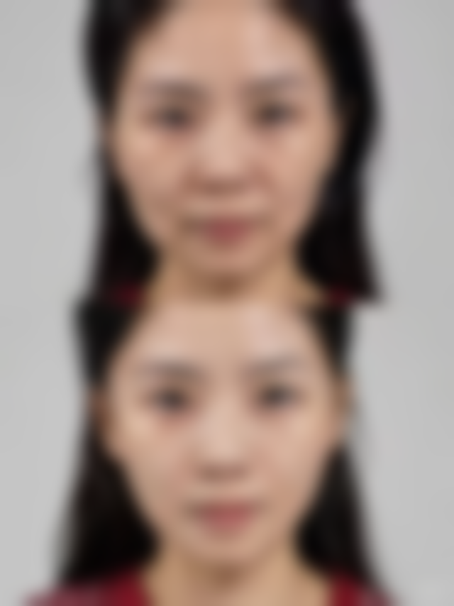 伊妍仕少女针注射部位