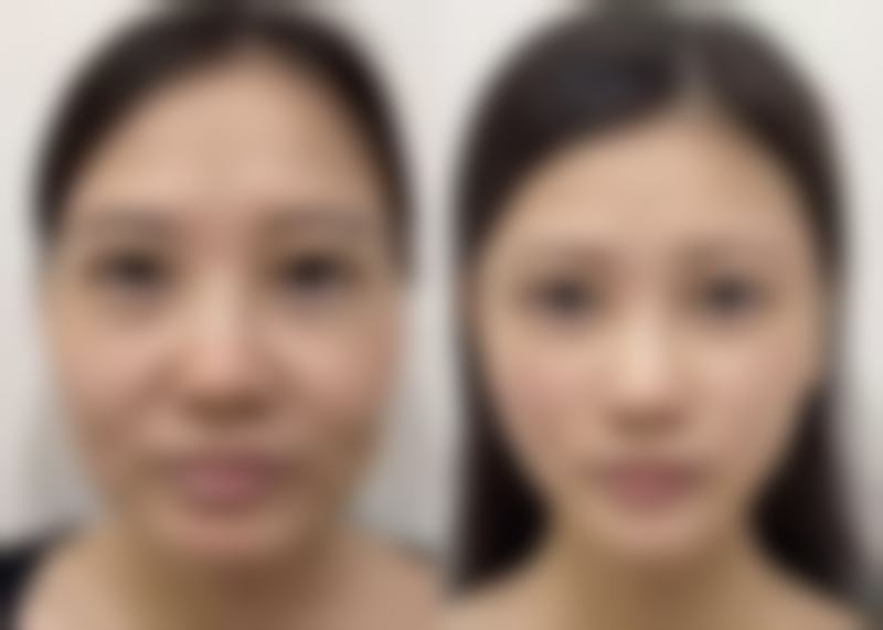 汕尾隐形矫正多少钱一次？爱顿、爱牙口腔价格大揭秘，最低 13500 元起！ 