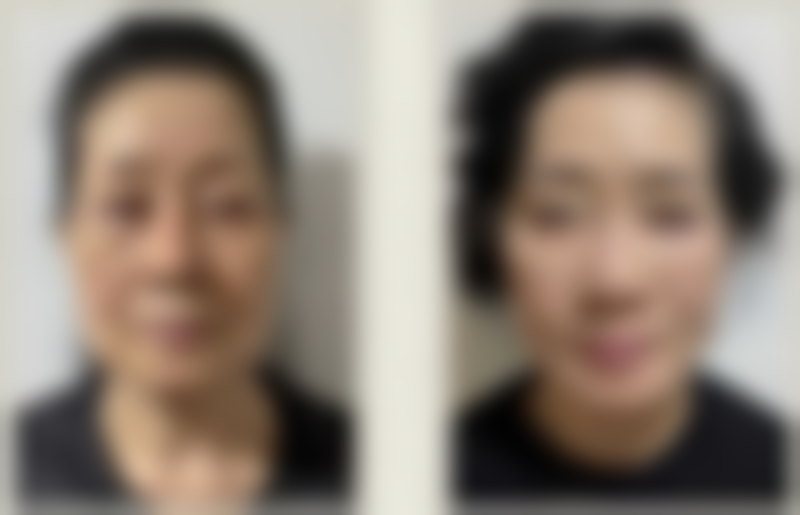 广州南方医院杜本军医生拉皮做的好，术后提升成效佳、维持久且切口不明显，口碑超赞！ 