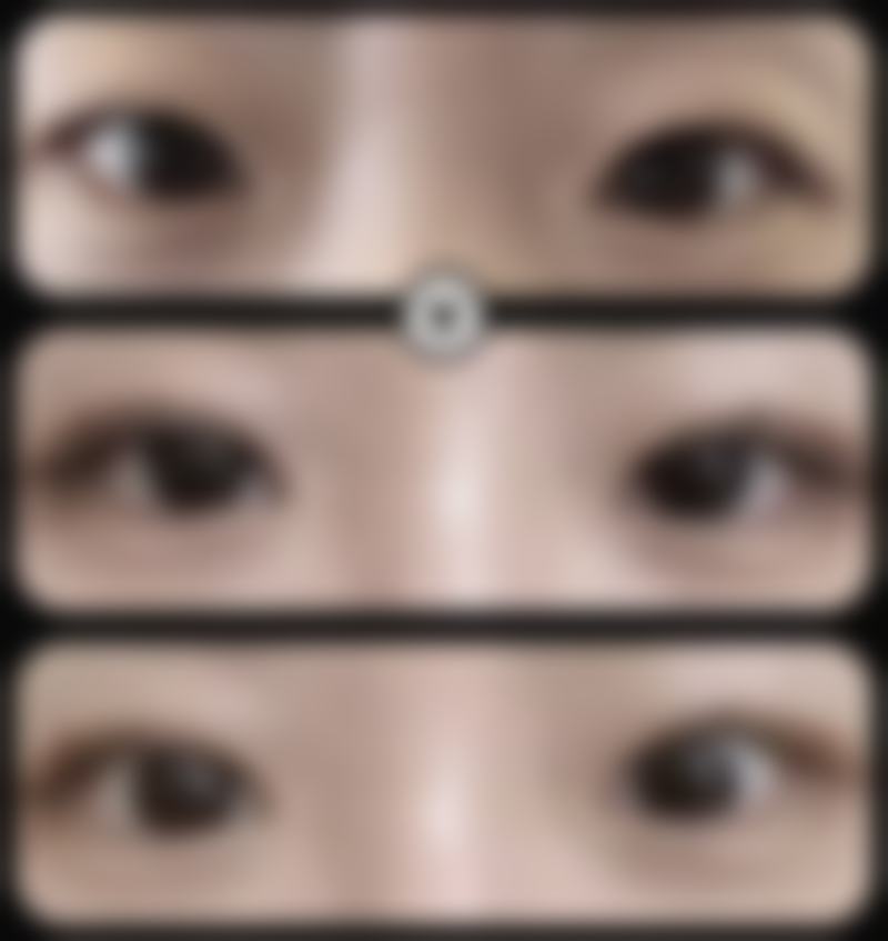 长春中妍眼部整形价格合理性
