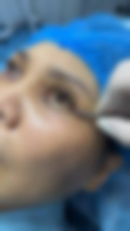 去眼袋什么更好更有效之射频治疗
