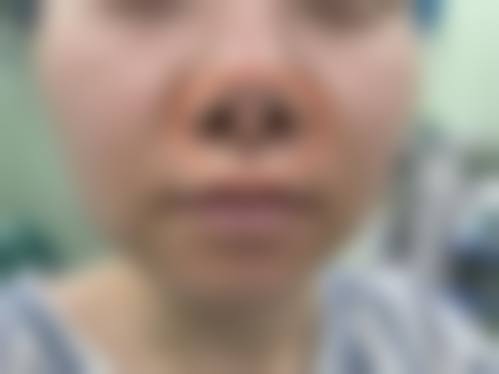 耳软骨隆鼻成效维持时间及特点