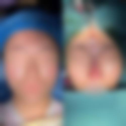 隆鼻哪种是永久的？硅胶、膨体等人工材料植入及护理得当的膨体隆鼻或可永久！ 