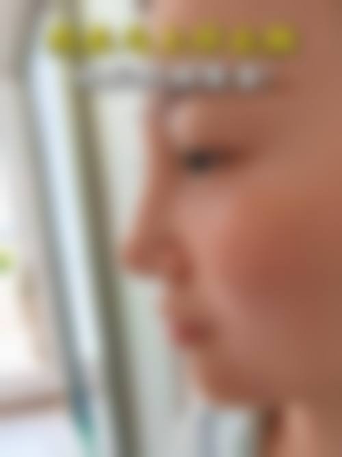 隆鼻效果是永久的吗？不同隆鼻方式如玻尿酸、假体、自体脂肪，维持时间大不同！ 