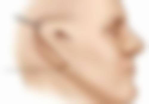 手术前后有哪些注意事项？