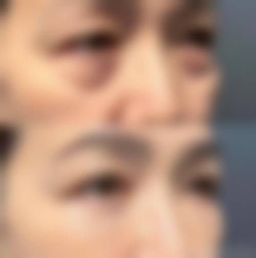 做完眼袋手术多久能修复正常：不同医生手术特点
