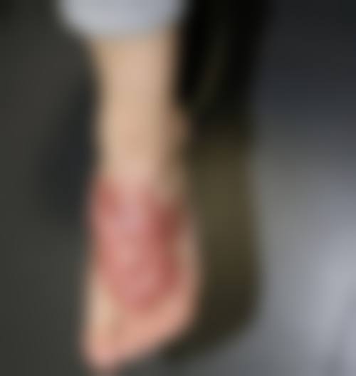 擅长治疗的疤痕类型