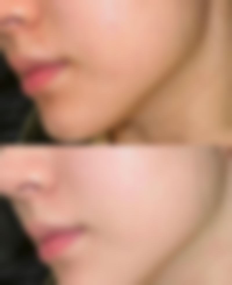 公主小脸馒化针可以打几次？一般3 - 6次/疗程，三次可维持5 - 8年效果超棒！ 